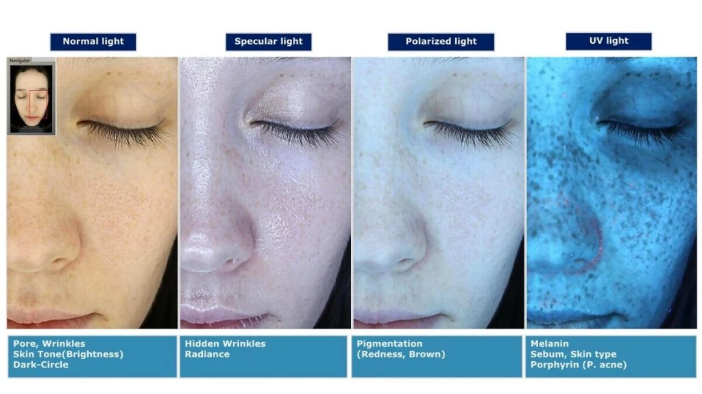 Skin analysis diagram comparing normal, specular, polarized and UV light