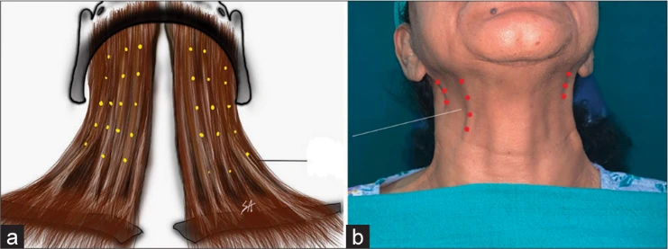 Neck rejuvenation treatment diagram