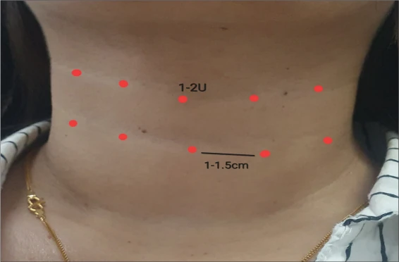 Venus ring injection placement diagram