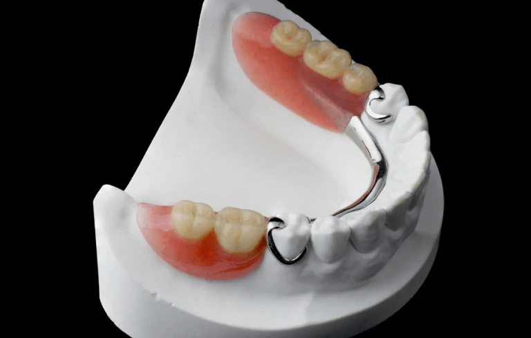 Cast partial denture on a dental model