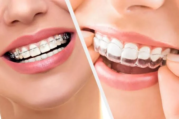 Comparison of metal braces and clear aligners