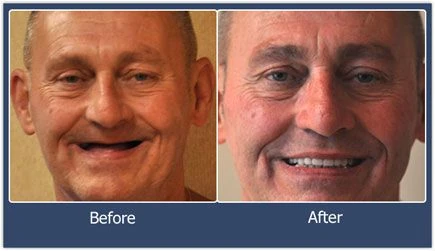 Smile comparison before and after complete dentures