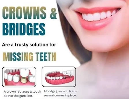 Crowns and bridges explanatory graphic