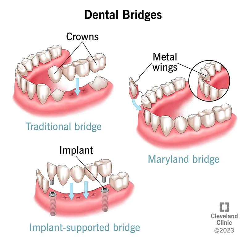 Diagram of four types of dental bridge