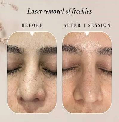 Freckle removal before and after comparison