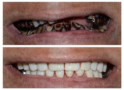 Smile comparison illustrating full mouth rehabilitation