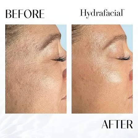 Hydrafacial before and after skin comparison