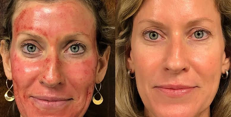 Facial skin comparison following microneedling