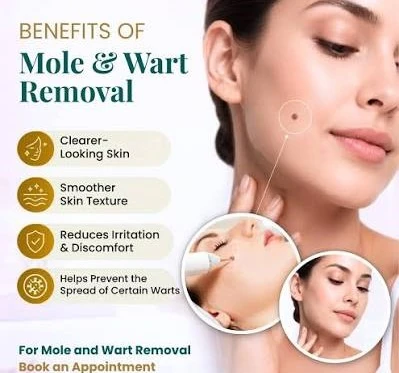 Mole and wart removal benefits infographic