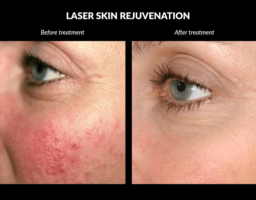 Laser skin rejuvenation before and after comparison