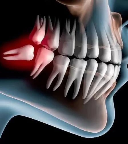 Impacted wisdom tooth illustration