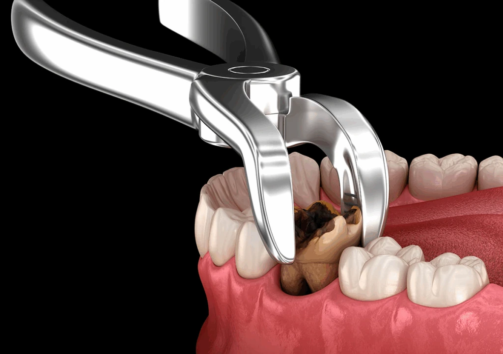 Tooth extraction illustration