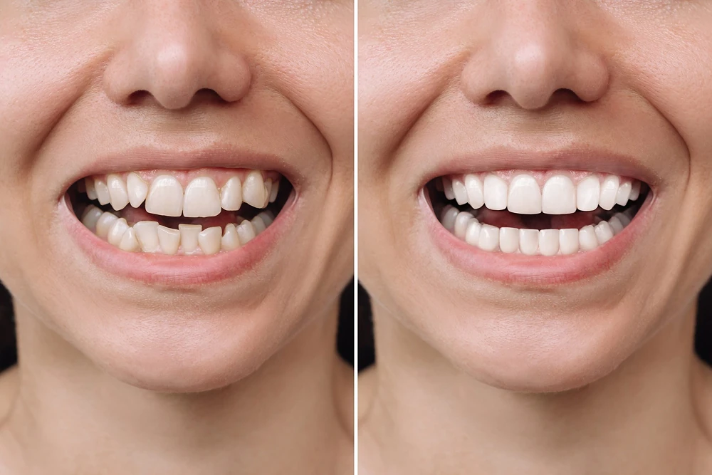 Smile comparison illustrating dental veneers